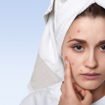Hormonal Acne Facials in Denver | Pur Luxe Beauty Bar