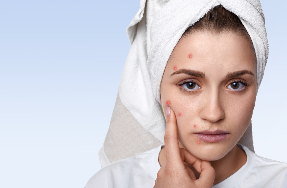 Hormonal Acne Facials in Denver | Pur Luxe Beauty Bar