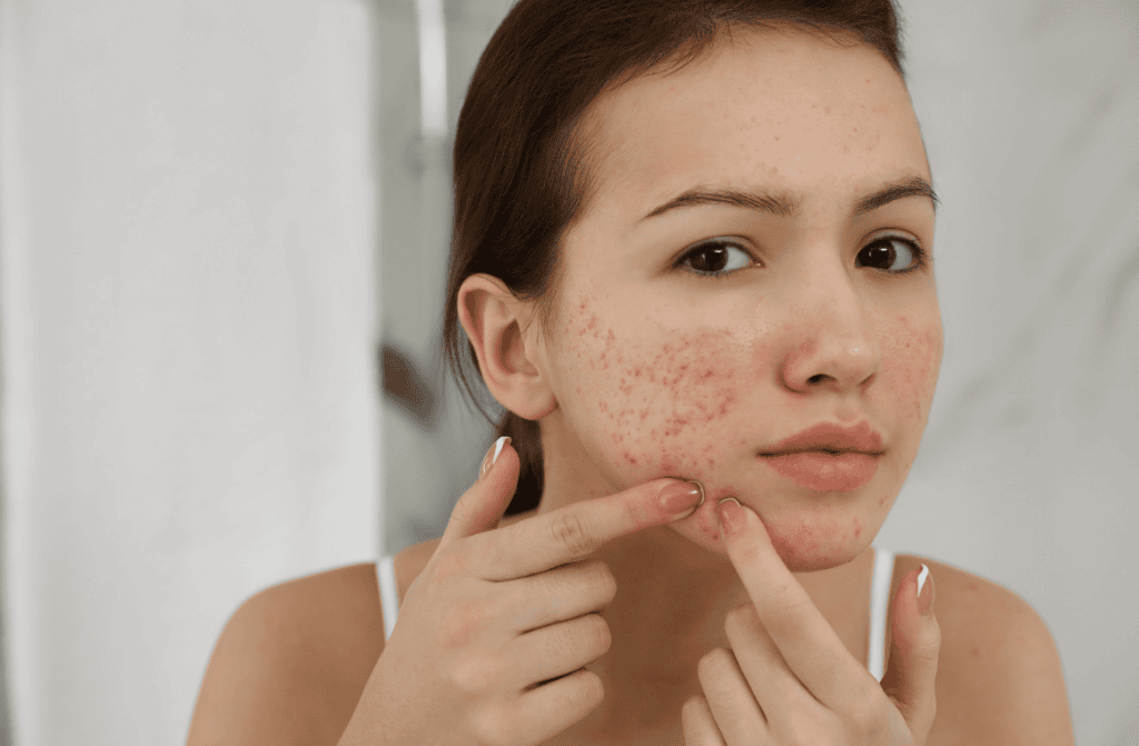 Hormonal Acne